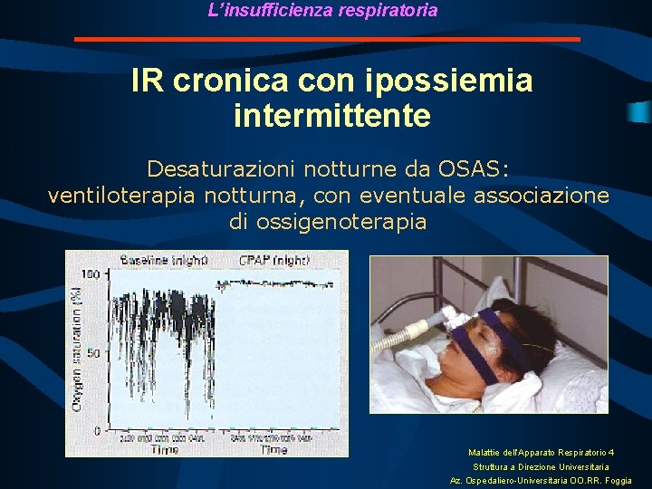 L’insufficienza respiratoria IR cronica con ipossiemia intermittente Desaturazioni notturne da OSAS: ventiloterapia notturna, con