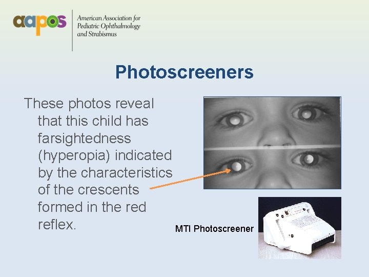 Photoscreeners These photos reveal that this child has farsightedness (hyperopia) indicated by the characteristics