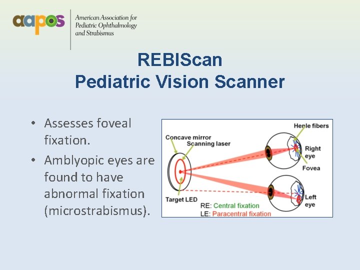 REBIScan Pediatric Vision Scanner • Assesses foveal fixation. • Amblyopic eyes are found to