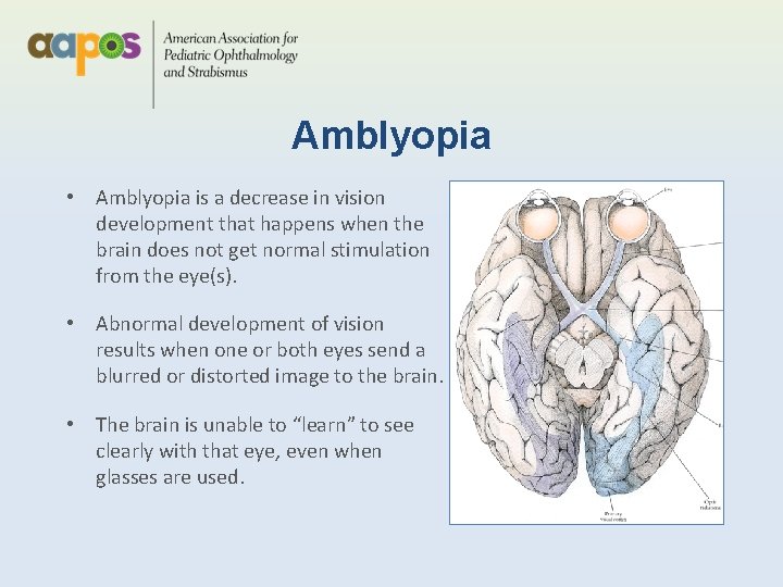 Amblyopia • Amblyopia is a decrease in vision development that happens when the brain