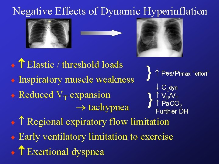 Negative Effects of Dynamic Hyperinflation Elastic / threshold loads ¨ Inspiratory muscle weakness ¨ Negative Effects of Dynamic Hyperinflation Elastic / threshold loads ¨ Inspiratory muscle weakness ¨