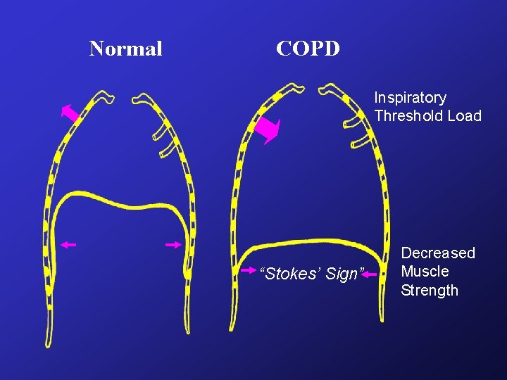Normal COPD Inspiratory Threshold Load “Stokes’ Sign” Decreased Muscle Strength Normal COPD Inspiratory Threshold Load “Stokes’ Sign” Decreased Muscle Strength
