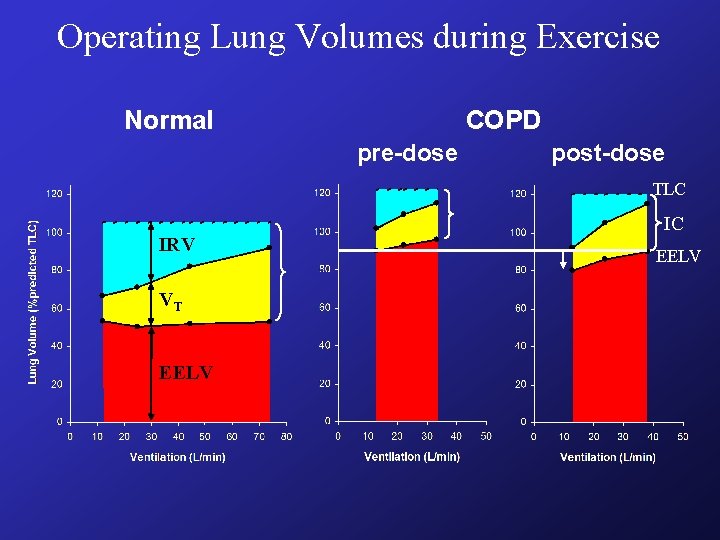 Operating Lung Volumes during Exercise Normal COPD pre-dose post-dose TLC IRV VT EELV IC Operating Lung Volumes during Exercise Normal COPD pre-dose post-dose TLC IRV VT EELV IC