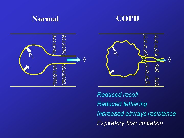 COPD Normal PL . V Reduced recoil Reduced tethering Increased airways resistance Expiratory flow COPD Normal PL . V Reduced recoil Reduced tethering Increased airways resistance Expiratory flow