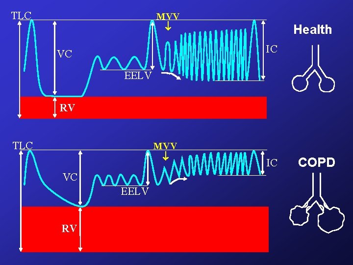 TLC MVV Health IC VC EELV RV TLC MVV VC EELV RV IC COPD TLC MVV Health IC VC EELV RV TLC MVV VC EELV RV IC COPD