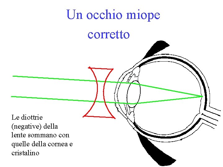 Un occhio miope corretto Le diottrie (negative) della lente sommano con quelle della cornea