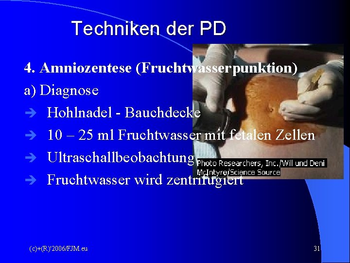 Techniken der PD 4. Amniozentese (Fruchtwasserpunktion) a) Diagnose Hohlnadel - Bauchdecke 10 – 25