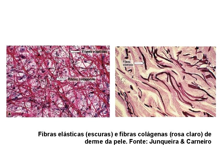 Fibras elásticas (escuras) e fibras colágenas (rosa claro) de derme da pele. Fonte: Junqueira