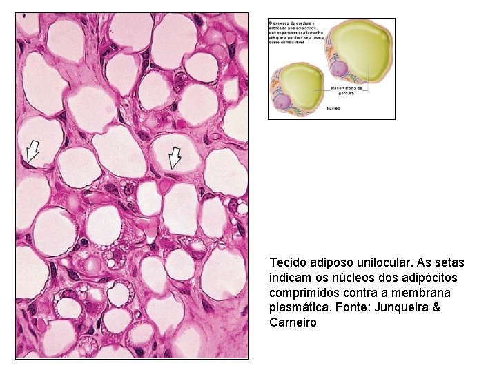 Tecido adiposo unilocular. As setas indicam os núcleos dos adipócitos comprimidos contra a membrana