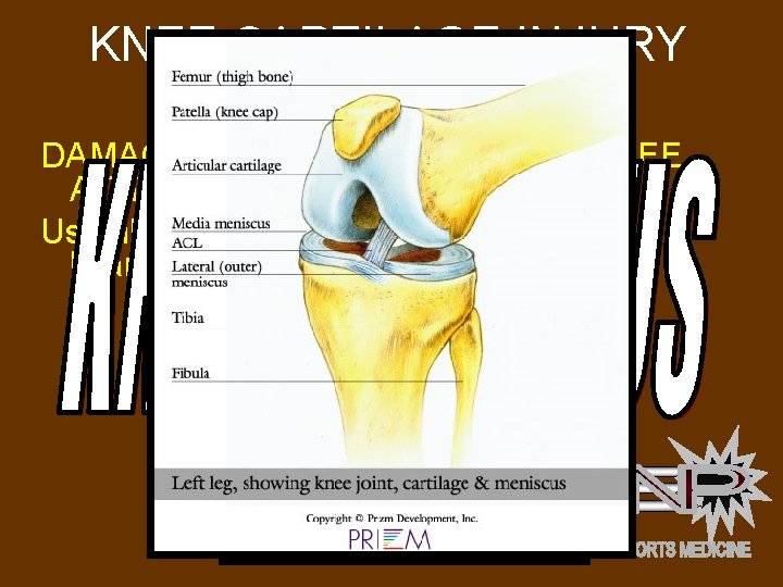 KNEE CARTILAGE INJURY MENISCUS INJURY DAMAGE TO CARTILAGE IN THE KNEE AT THE TOP