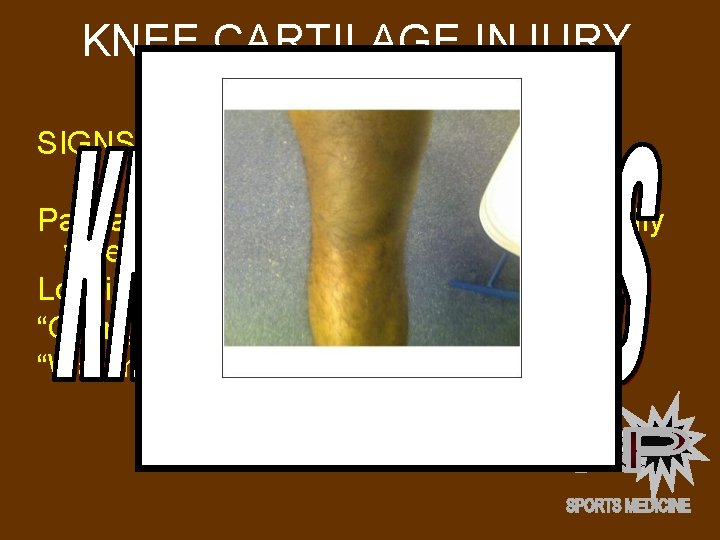 KNEE CARTILAGE INJURY MENISCUS INJURY SIGNS AND SYMPTOMS: Pain and Tenderness in the knee,