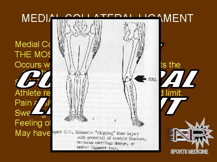 MEDIAL COLLATERAL LIGAMENT INJURY Medial Collateral Ligament (MCL) THE MOST COMMON Occurs when opponent