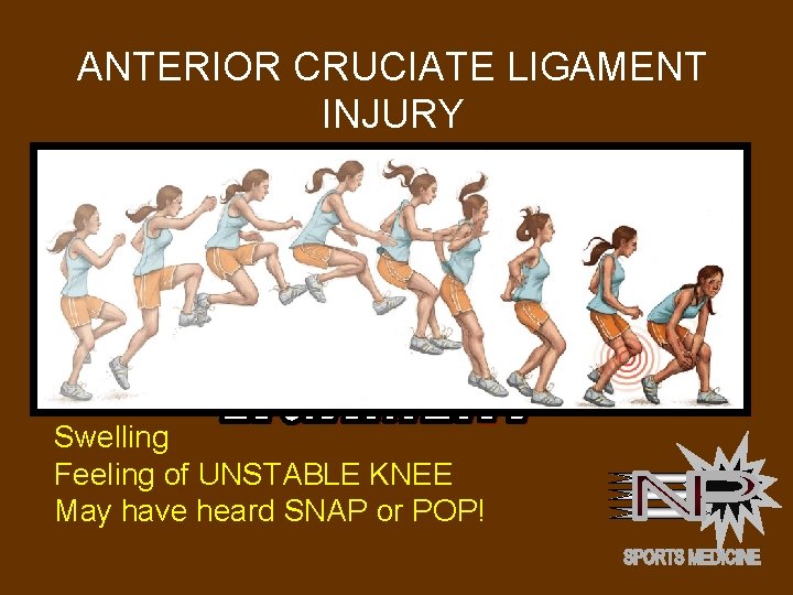 ANTERIOR CRUCIATE LIGAMENT INJURY Anterior Cruciate Ligament (ACL) Occurs when athlete makes a very