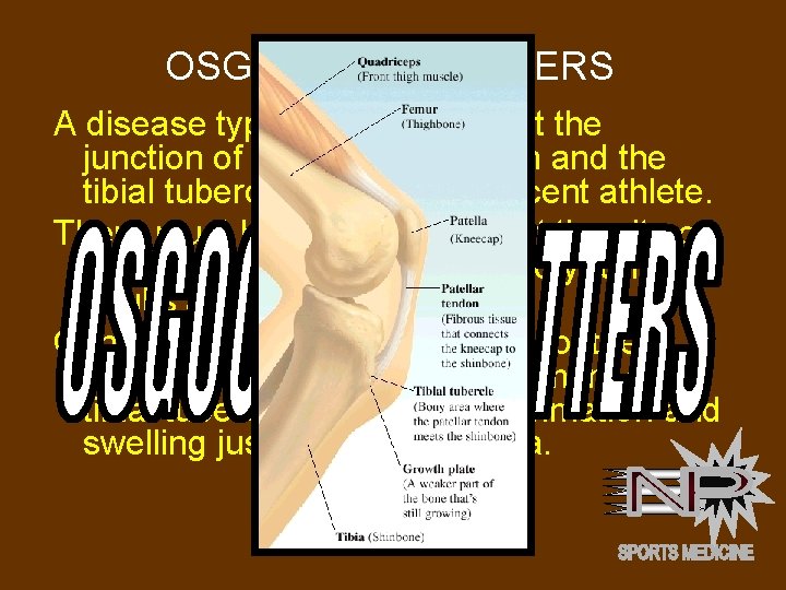 OSGOOD-SCHLATTERS A disease typically a problem at the junction of the patellar tendon and