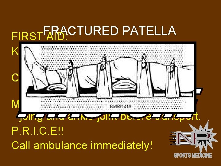 FRACTURED PATELLA FIRST AID: Keep person warm with blankets to decrease shock risk. Cut