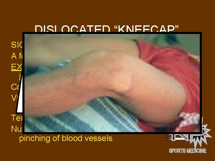 DISLOCATED “KNEECAP” SIGNS AND SYMPTOMS: A feeling of the knee “giving way” EXCRUTIATING pain