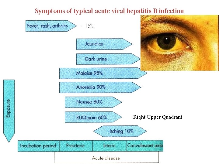 Symptoms of typical acute viral hepatitis B infection Right Upper Quadrant 