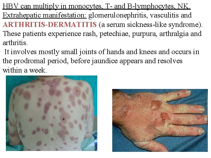 HBV can multiply in monocytes, T- and B-lymphocytes, NK. Extrahepatic manifestation: glomerulonephritis, vasculitis and