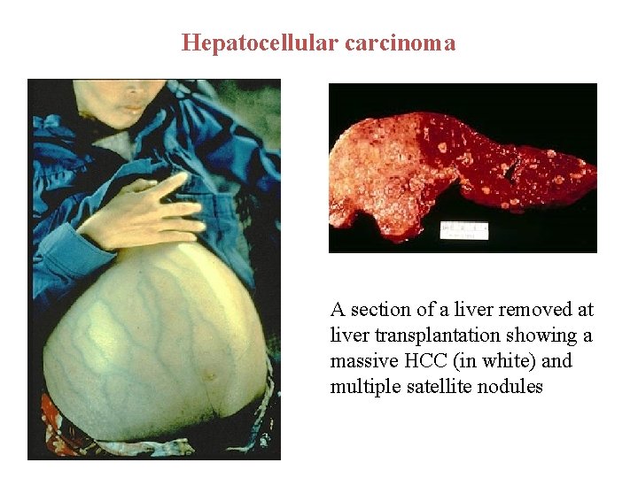 Hepatocellular carcinoma A section of a liver removed at liver transplantation showing a massive