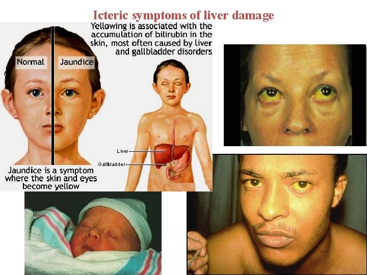 Icteric symptoms of liver damage 