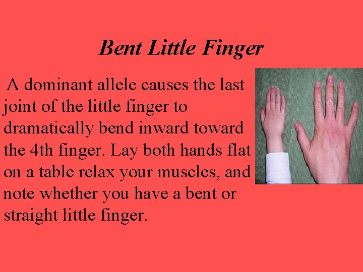 Bent Little Finger A dominant allele causes the last joint of the little finger