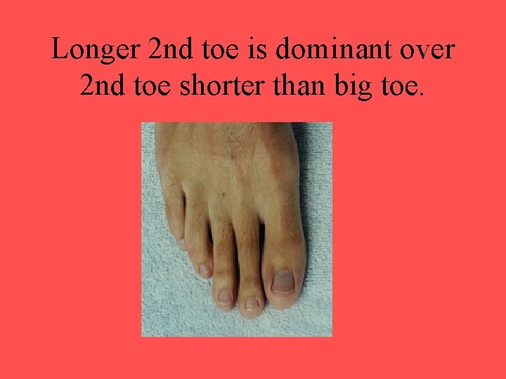 Longer 2 nd toe is dominant over 2 nd toe shorter than big toe.