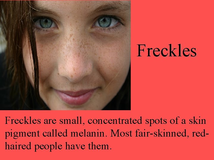 Freckles are small, concentrated spots of a skin pigment called melanin. Most fair-skinned, redhaired