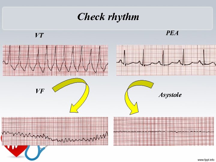 Check rhythm VT PEA VF Asystole 