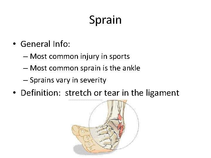 Sprain • General Info: – Most common injury in sports – Most common sprain