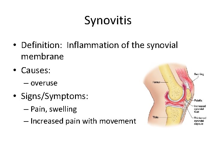 Synovitis • Definition: Inflammation of the synovial membrane • Causes: – overuse • Signs/Symptoms: