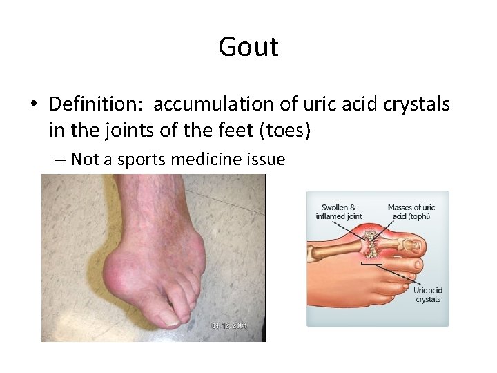 Gout • Definition: accumulation of uric acid crystals in the joints of the feet
