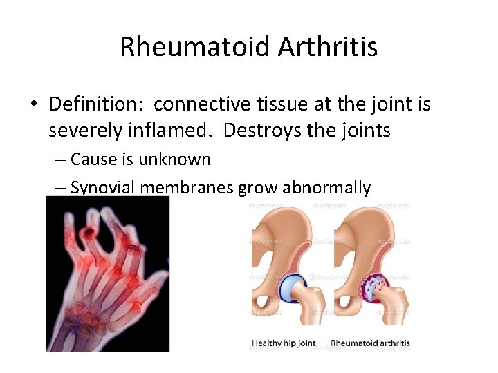 Rheumatoid Arthritis • Definition: connective tissue at the joint is severely inflamed. Destroys the