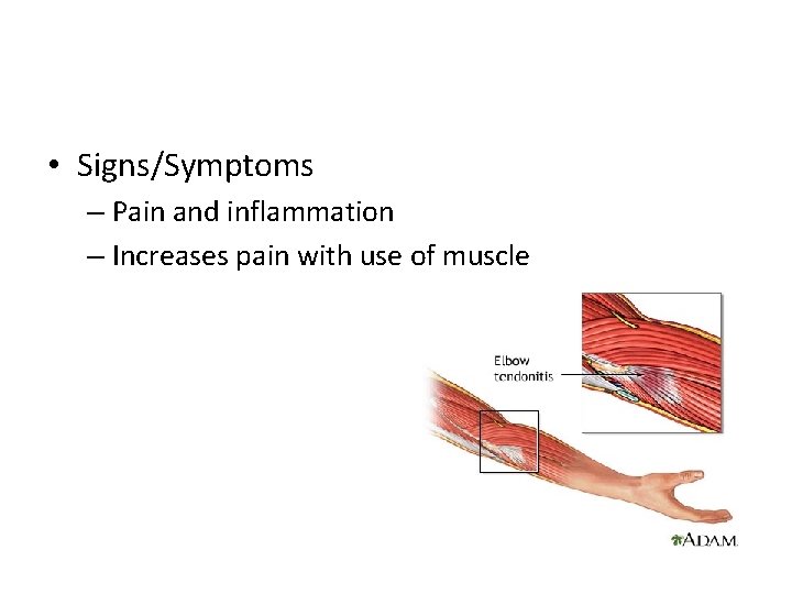  • Signs/Symptoms – Pain and inflammation – Increases pain with use of muscle