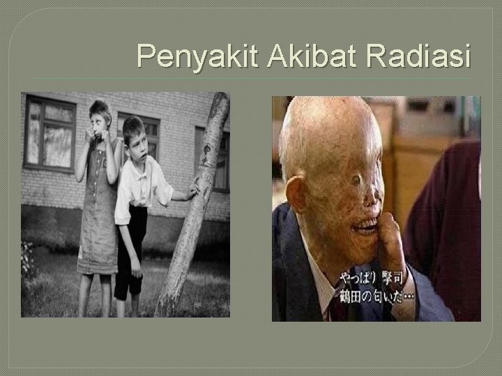 Penyakit Akibat Radiasi 