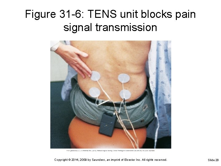 Figure 31 -6: TENS unit blocks pain signal transmission Copyright © 2014, 2009 by