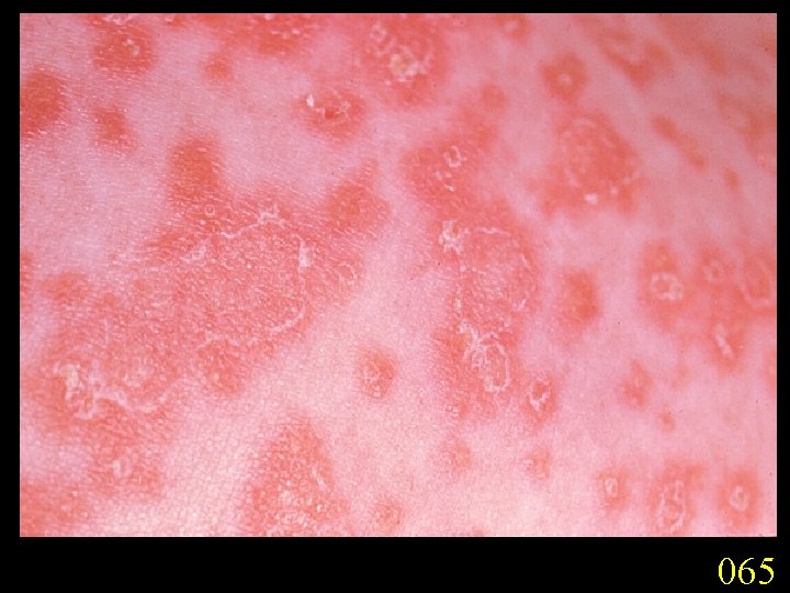 065 