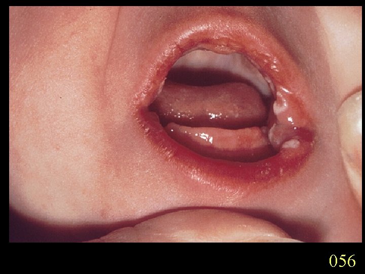 056 