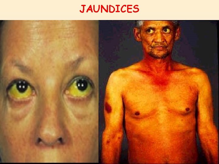 JAUNDICES JAUNDICES