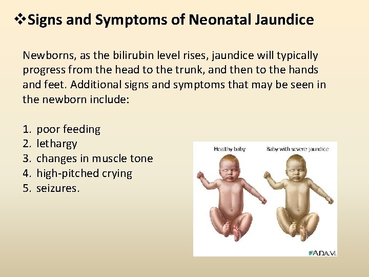v. Signs and Symptoms of Neonatal Jaundice Newborns, as the bilirubin level rises, jaundice v. Signs and Symptoms of Neonatal Jaundice Newborns, as the bilirubin level rises, jaundice