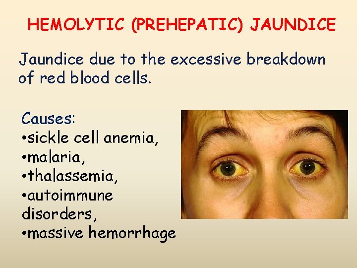 HEMOLYTIC (PREHEPATIC) JAUNDICE Jaundice due to the excessive breakdown of red blood cells. Causes: HEMOLYTIC (PREHEPATIC) JAUNDICE Jaundice due to the excessive breakdown of red blood cells. Causes:
