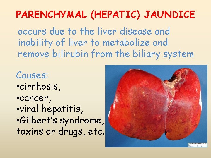 PARENCHYMAL (HEPATIC) JAUNDICE occurs due to the liver disease and inability of liver to PARENCHYMAL (HEPATIC) JAUNDICE occurs due to the liver disease and inability of liver to