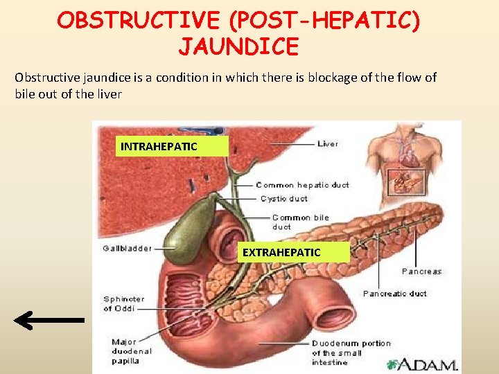 ОBSTRUCTIVE (POST-HEPATIC) JAUNDICE Obstructive jaundice is a condition in which there is blockage of ОBSTRUCTIVE (POST-HEPATIC) JAUNDICE Obstructive jaundice is a condition in which there is blockage of