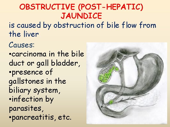ОBSTRUCTIVE (POST-HEPATIC) JAUNDICE is caused by obstruction of bile flow from the liver Causes: ОBSTRUCTIVE (POST-HEPATIC) JAUNDICE is caused by obstruction of bile flow from the liver Causes:
