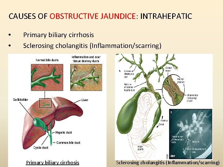 CAUSES OF OBSTRUCTIVE JAUNDICE: INTRAHEPATIC • • Primary biliary cirrhosis Sclerosing cholangitis (Inflammation/scarring) CAUSES OF OBSTRUCTIVE JAUNDICE: INTRAHEPATIC • • Primary biliary cirrhosis Sclerosing cholangitis (Inflammation/scarring)