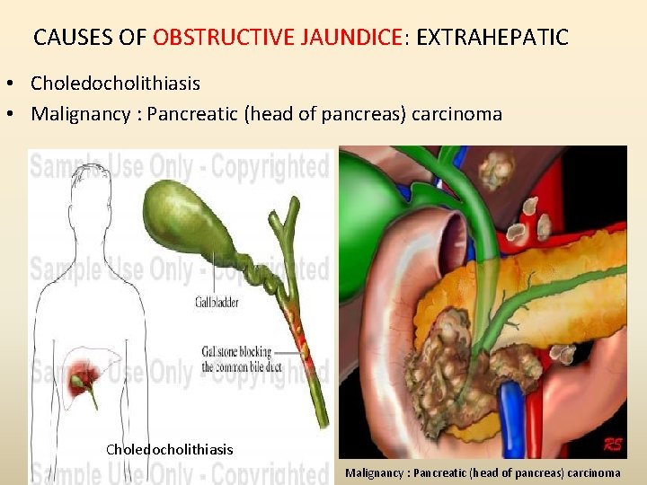 CAUSES OF OBSTRUCTIVE JAUNDICE: EXTRAHEPATIC • Choledocholithiasis • Malignancy : Pancreatic (head of pancreas) CAUSES OF OBSTRUCTIVE JAUNDICE: EXTRAHEPATIC • Choledocholithiasis • Malignancy : Pancreatic (head of pancreas)