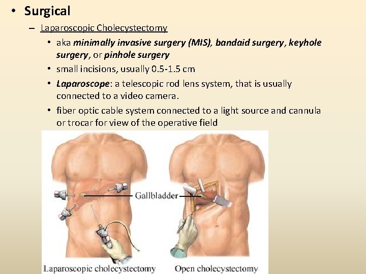 • Surgical – Laparoscopic Cholecystectomy • aka minimally invasive surgery (MIS), bandaid surgery, • Surgical – Laparoscopic Cholecystectomy • aka minimally invasive surgery (MIS), bandaid surgery,