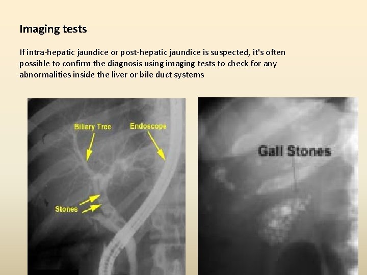 Imaging tests If intra-hepatic jaundice or post-hepatic jaundice is suspected, it's often possible to Imaging tests If intra-hepatic jaundice or post-hepatic jaundice is suspected, it's often possible to