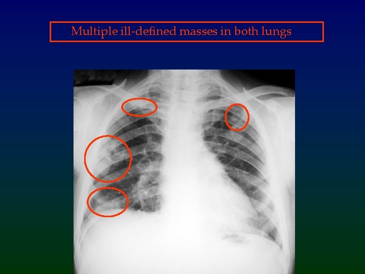 Multiple ill-defined masses in both lungs 