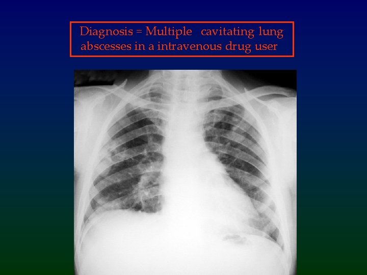 Diagnosis = Multiple cavitating lung abscesses in a intravenous drug user 