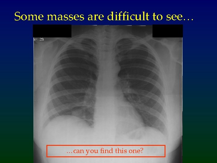 Some masses are difficult to see… …can you find this one? 